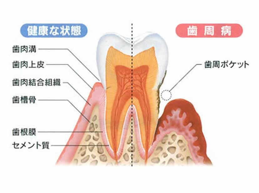 歯を失う原因No.1の歯周病の説明写真