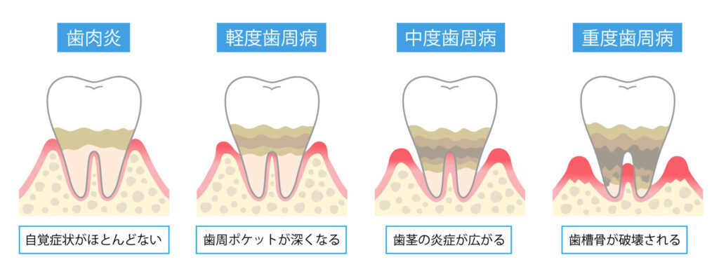 なぜ歯周病の症状が起きるの？～歯周炎から重度の歯周病まで～